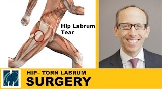 Hip Pain  Torn Labrum Hip [upl. by Nimzay]