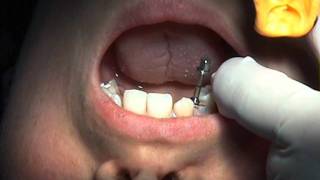 Perform the Ultimate Atraumatic Extractin with the Easy X Trac System [upl. by Anilak244]