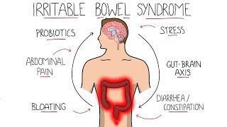 Irritable Bowel Syndrome IBS  Including Symptoms Criteria amp Treatment [upl. by Elson]