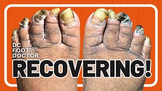 Recovering Trimming Fungal Toenails [upl. by Avrit]