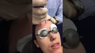 Erbium Yag Laser Treatment using Asclepion MCL31 Dermablate [upl. by Yelena]