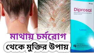 Diprosal lotionquotমাথার এলার্জি থেকে মুক্তির সহজ উপায়। [upl. by Nyssa]