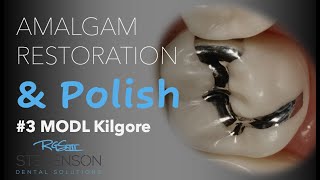 Amalgam Restoration and Polish 3 MOL Kilgore [upl. by Winwaloe977]