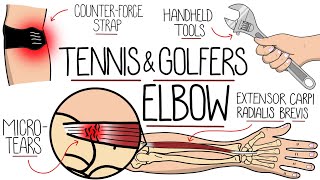 Understanding Tennis Elbow and Golfers Elbow Lateral amp Medial Epicondylitis [upl. by Kendry645]