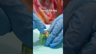 Get Teeth Scaling amp Polishing Treatment in Karachi  HASH CLINICS [upl. by Akiner]