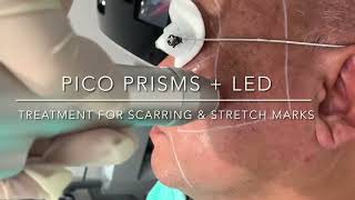 Pico Laser Treatment  Skincare Laser Clinic Point Cook [upl. by Haldan]