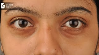 5 Natural remedies to remove dark circles  Dr Mini Nair [upl. by Kristyn]