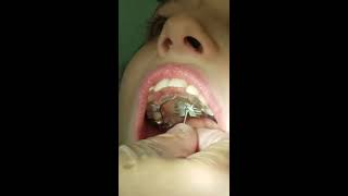 OkunOrtho Turning the key on a palatal expander [upl. by Whipple923]