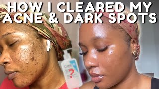 HOW I CLEARED MY ACNE BREAKOUTS AND DARK SPOTS NO TRETINOIN  iJay Amadi [upl. by Acirederf]