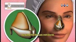 O QUE É RINOPLASTIA Video Como é feita Dói Quais as indicações e riscos [upl. by Rochester571]