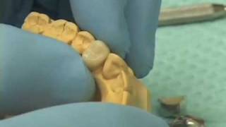 Fabricating Provisional Crowns [upl. by Berkie]