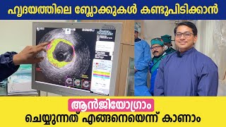 ഹൃദയത്തിലെ ബ്ലോക്കുകൾ കണ്ടുപിടിക്കാൻ ആൻജിയോഗ്രാം ചെയ്യുന്നത് കാണാം  Angiogram Malayalam video [upl. by Nnitsuj217]