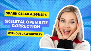 Spark Clear Aligners Skeletal Openbite Correction Without Jaw Surgery [upl. by Grider]