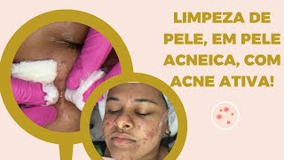 Limpeza de pele profissional em pele acneica com acne ativa [upl. by Lynnett]