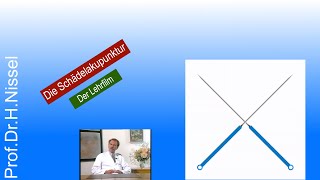 Schädelakupunktur  anschaulich demonstriert [upl. by Scriven674]