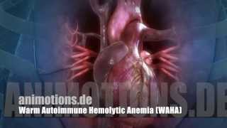 WAHA Warm Autoimmune Hemolytic Anemia AIHA [upl. by Neelram]