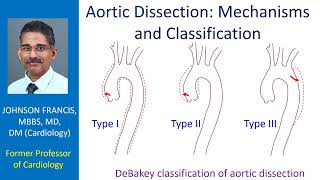 Aortic Dissection – Mechanisms and Classification [upl. by Anelav449]