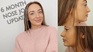 6 MONTH RHINOPLASTY UPDATE Swelling Pain etc [upl. by Lala]