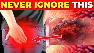 Critical Colon Cancer Symptoms You Should Never Ignore [upl. by Nuhsar]