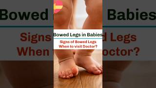 Physiological Bow legs Expert advice Dr Imran Patel childgrowth childdevelopment shortsfeed [upl. by Ferri]