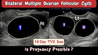 TVS Ultrasound  Bilateral multiple Ovarian Follicular Cysts [upl. by Notserp729]