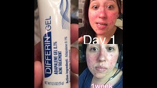 Differin gel acne treatment part 1 [upl. by Attirb]