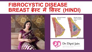 FIBROCYSTIC DISEASE BREAST ब्रेस्ट में सिस्ट HINDI [upl. by Oal]