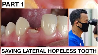 Step by Step Saving Lateral Hopeless Tooth Part 1  General Dentist Griya RR [upl. by Enicnarf61]