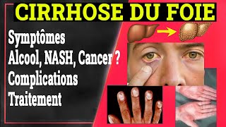 Cirrhose du Foie Clinique Complications Traitement  Gastrologie Medicale [upl. by Anilegna]