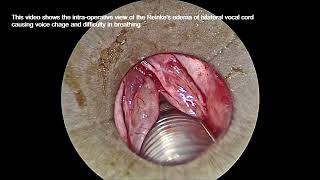 Reinkes edema surgical videos [upl. by Weitman]