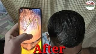 Hair regrowth resultleech therepy leech oil result by DrSalman [upl. by Carol-Jean]