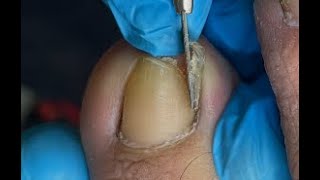 Huge ingrown toenail removal [upl. by Viking]