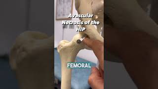 HOW DO YOU GET BONE NECROSIS OF THE HIP [upl. by Alejandrina]