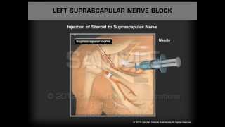 Left Suprascapular Nerve Block [upl. by Woolson]