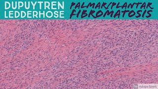 Palmar Fibromatosis Dupuytren Contracture amp Plantar Fibromatosis 5Minute Pathology Pearls [upl. by Caitrin]