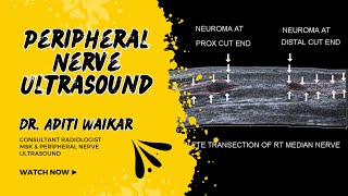 Case 3 Peripheral Nerve Ultrasound Case Diaries [upl. by Slavin]