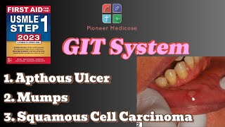 USMLE Step 1 Oral pathologies Oral cavity cancer from first aid step 1UrduHindi [upl. by Suoiluj]