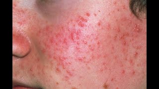 Acne Symptoms and Causes  Diagnosis  Treatment  Prevention [upl. by Eelrahs]