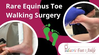 Rare Form of Equinus Toe Walking Surgery Success 6 Month Recovery [upl. by Sevart629]