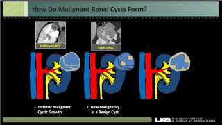 Imaging renal cystic masses [upl. by Durrett]