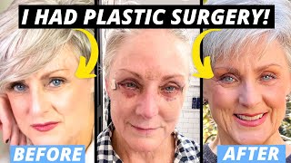 Everything about my blepharoplasty plastic surgery [upl. by Leirvag980]