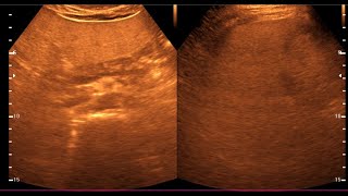 Fatty Liver  Diffuse hepatic steatosis  Liver Ultrasonogram [upl. by Adniral]