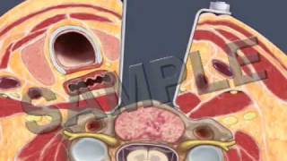 Anterior Cervical Fusion 3D2D Medical Animation [upl. by Novhaj]