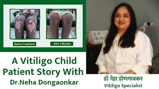 A Vitiligo Child Patient Story With DrNeha Dongaonkar  Children Vitiligo Best Treatment [upl. by Manaker903]