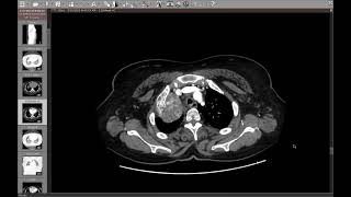 7case 7 1st rib chondrosarcoma [upl. by Ydnal]