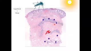 Perivascular Dermatitis Dr Hany Osman [upl. by Adnovaj360]