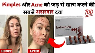 Isotroin20 Capsuleकील मुंहासे और दाग धब्बों को हटाने का सबसे असरदार कैप्सूलUsesDosesFull Review [upl. by Annoda534]