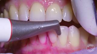 How teeth should be cleaned at the Dentist  Hygienist [upl. by Initsed]