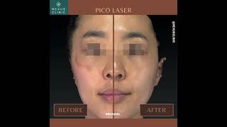 PICO Laser Treatment  Pigmentation nexuskl nexusclinic [upl. by Jaclyn]