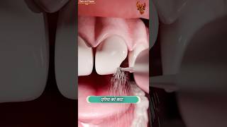 How teeth are fixed 😳 दांत कैसे ठीक होते हैं  shorts [upl. by Schaper]